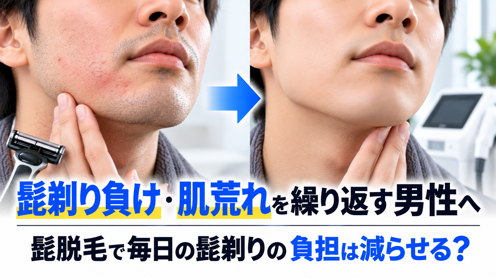 髭剃り負け・肌荒れを繰り返す男性へ｜髭脱毛で毎日の髭剃りの負担は減らせる？